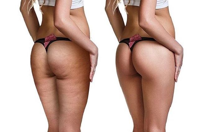 eliminare cellulite